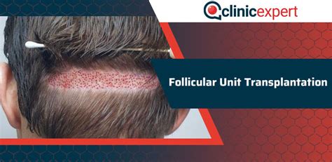 lcf hair transplant|Follicular unit transplantation .